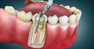 Root Canal Treatments images